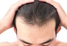 The Causes of Hair Loss in Men