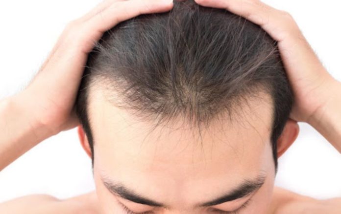 The Causes of Hair Loss in Men