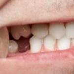 What to Do in the Event of Losing Your Teeth